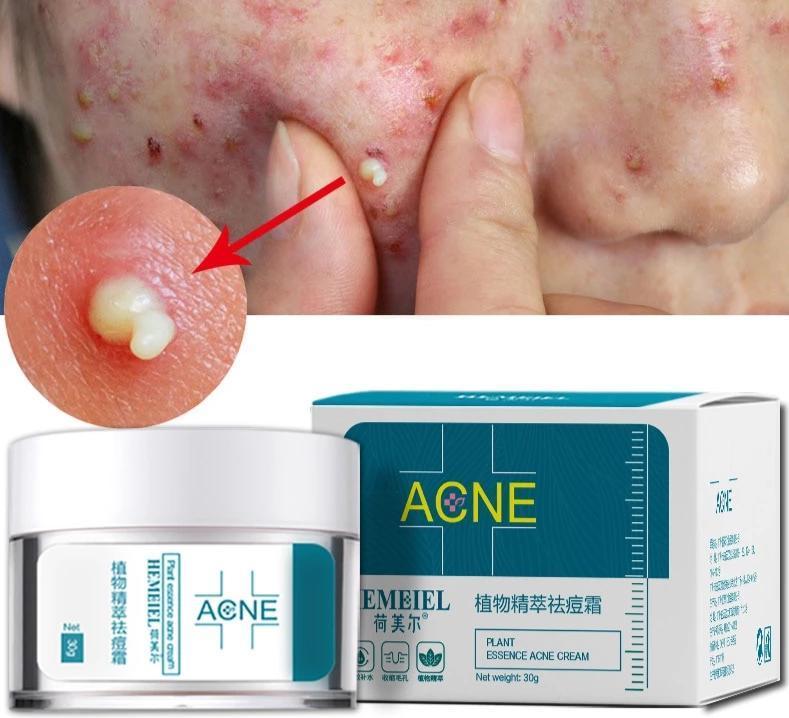 πΉ Anti-Acne Cream β π― Targeted Care β π§΄ Blemish-Prone Skin