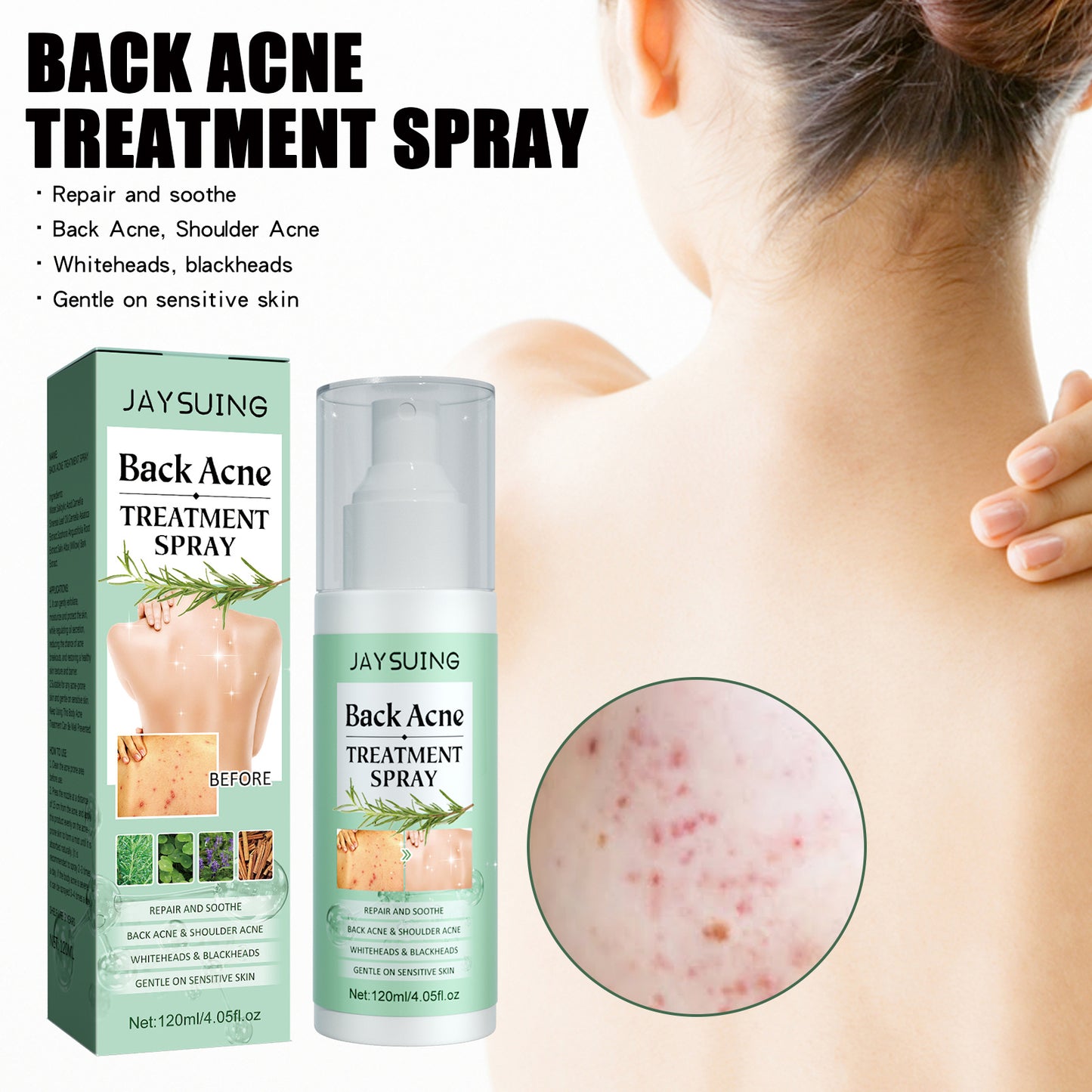 πΉ Back Anti-Acne β π₯ Pimples β’ π§ Hydrates β’ π‘οΈ Purifies β’ β¨ Repairs π₯ Fades Marks
