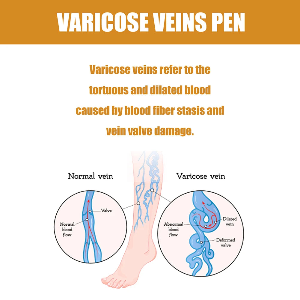 π‘β¨ LED Therapy Pen β Relief for Varicose Veins & Improved Circulation β¨π‘