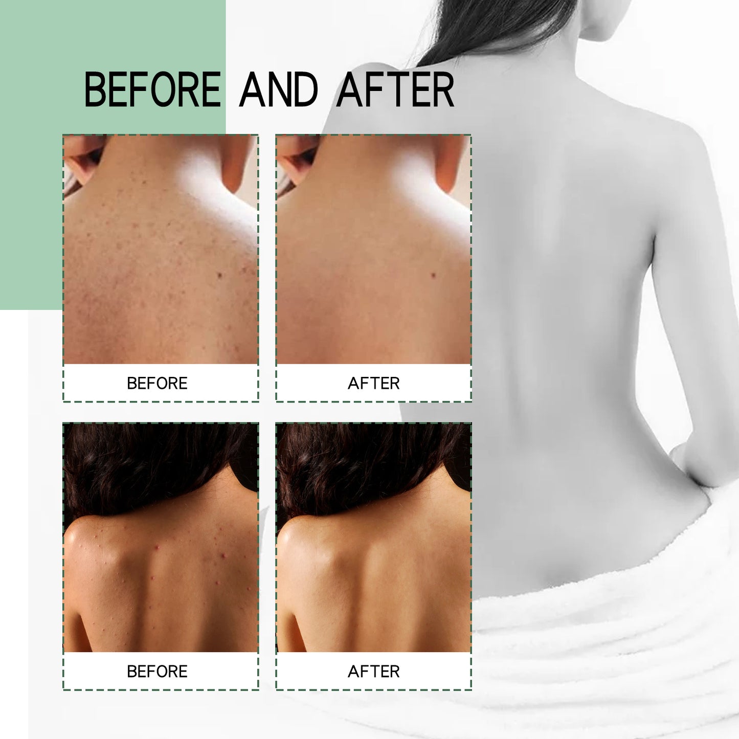 πΉ Back Anti-Acne β π₯ Pimples β’ π§ Hydrates β’ π‘οΈ Purifies β’ β¨ Repairs π₯ Fades Marks