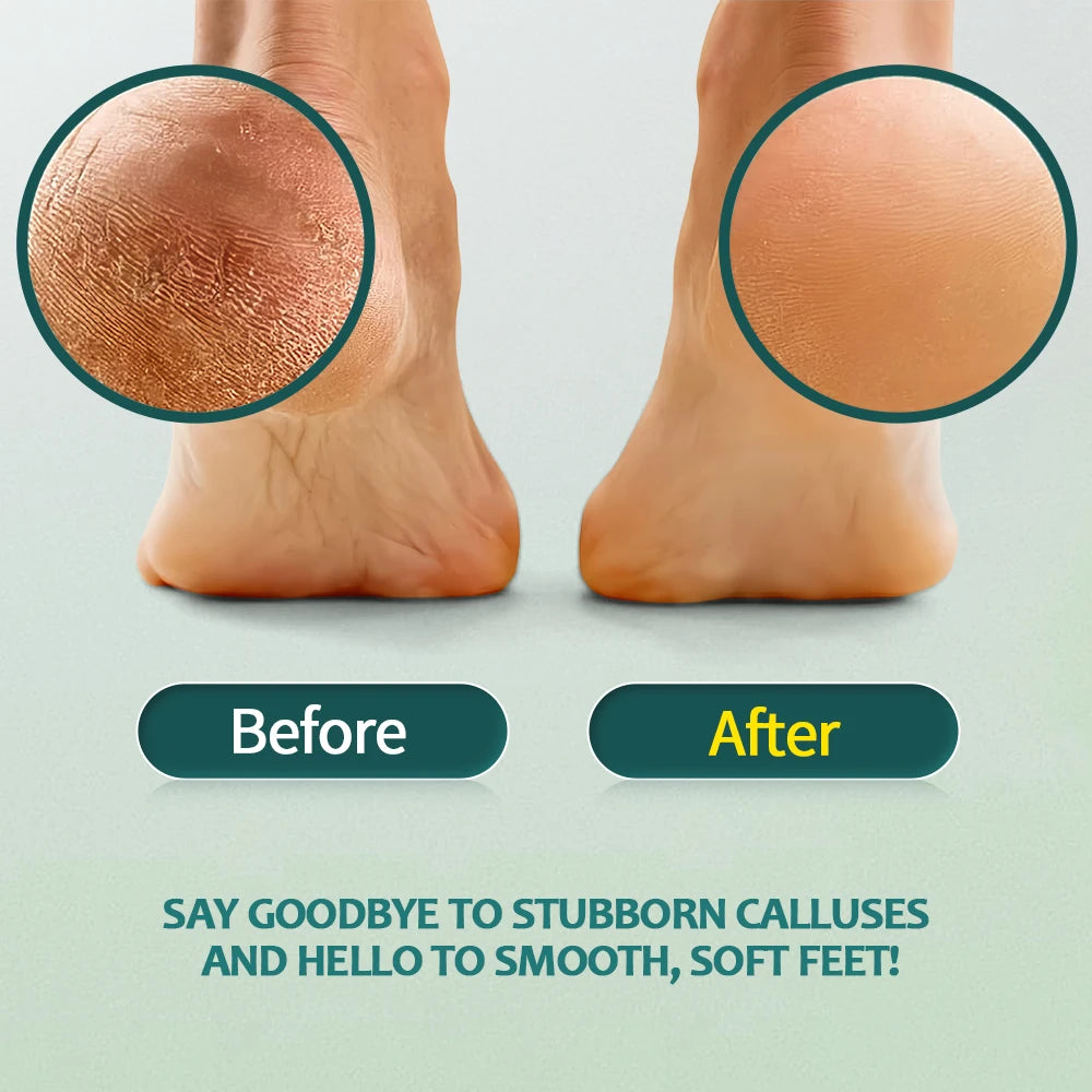 🦶✨ Nailpop Professional Callus Remover Kit – Extra Strength Gel & Foot File ✨🦶