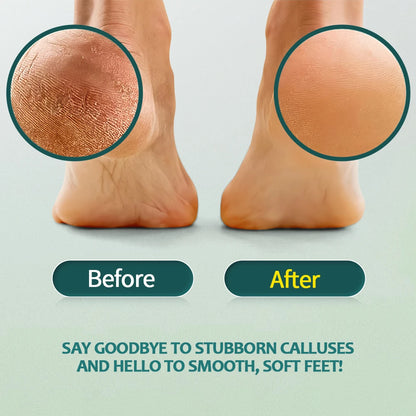 🦶✨ Nailpop Professional Callus Remover Kit – Extra Strength Gel & Foot File ✨🦶