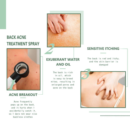 🔹 Back Anti-Acne – 🔥 Pimples • 💧 Hydrates • 🛡️ Purifies • ✨ Repairs 💥 Fades Marks
